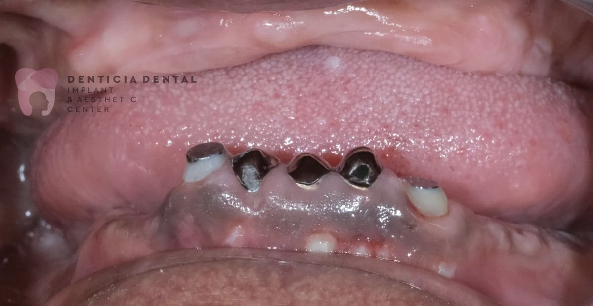 After Overdenture 1