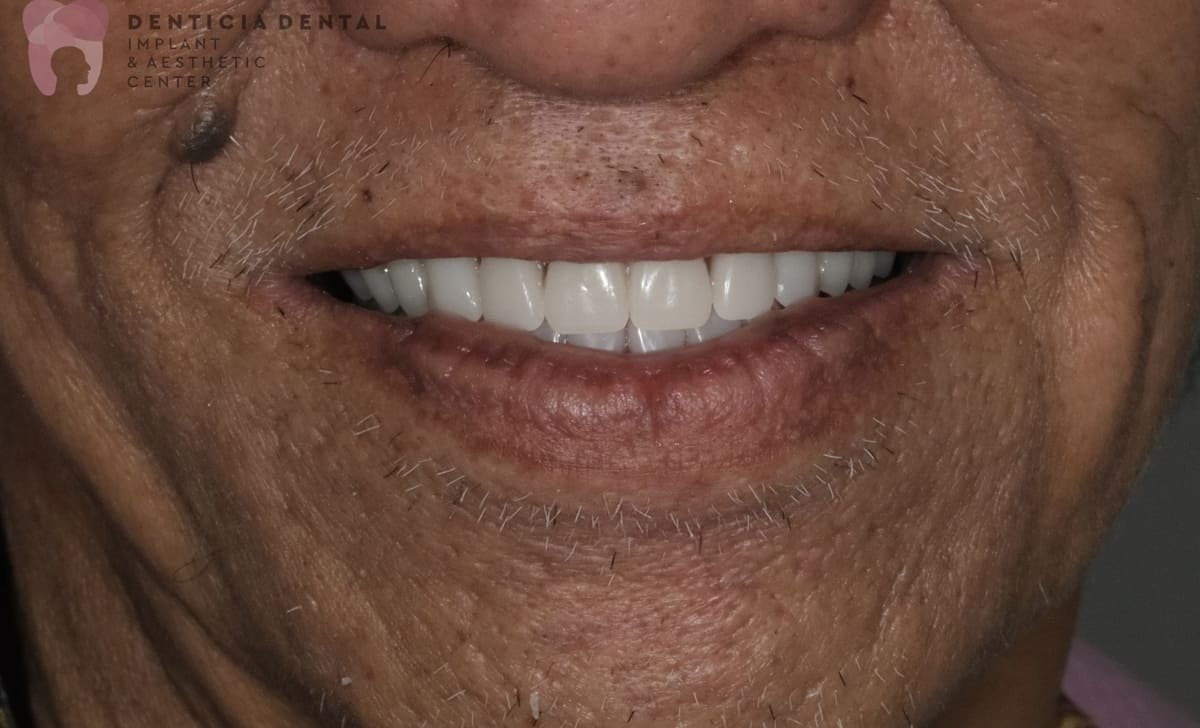 After Overdenture 2