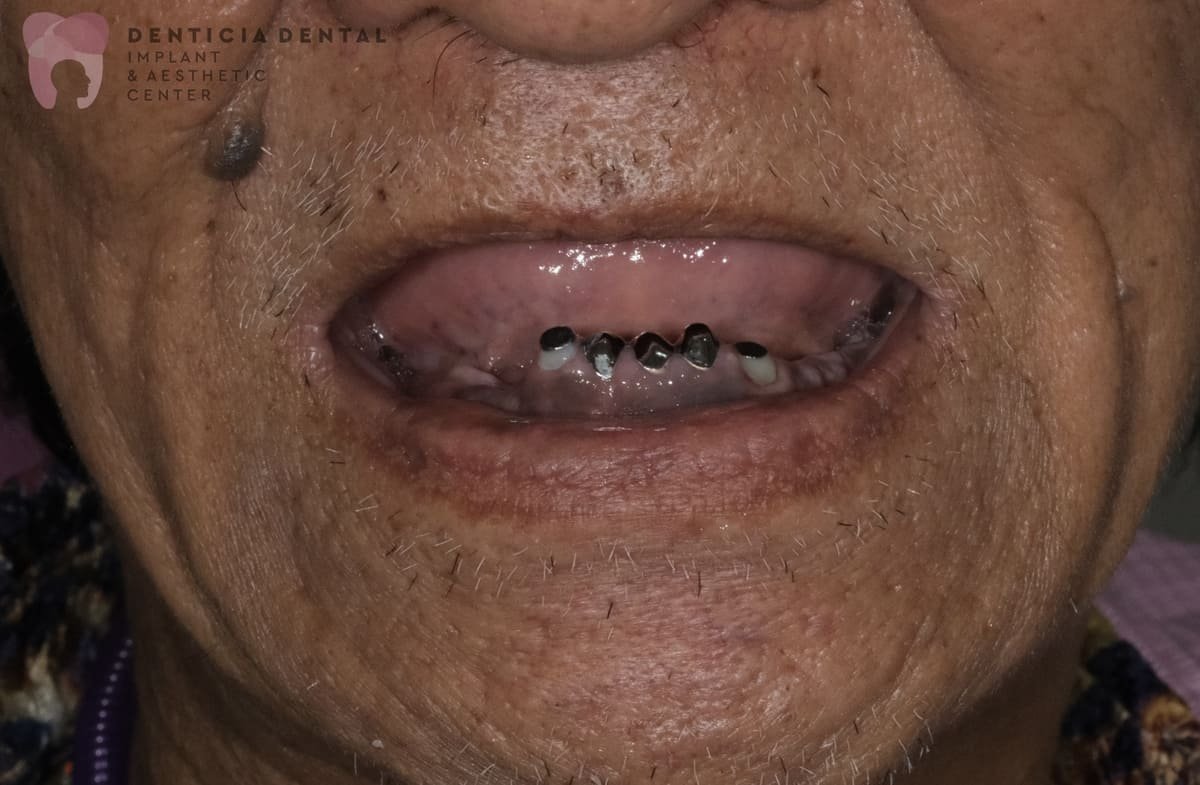 After Overdenture 2(1)