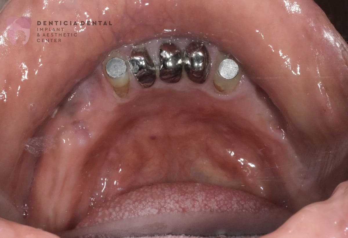 After Overdenture 3