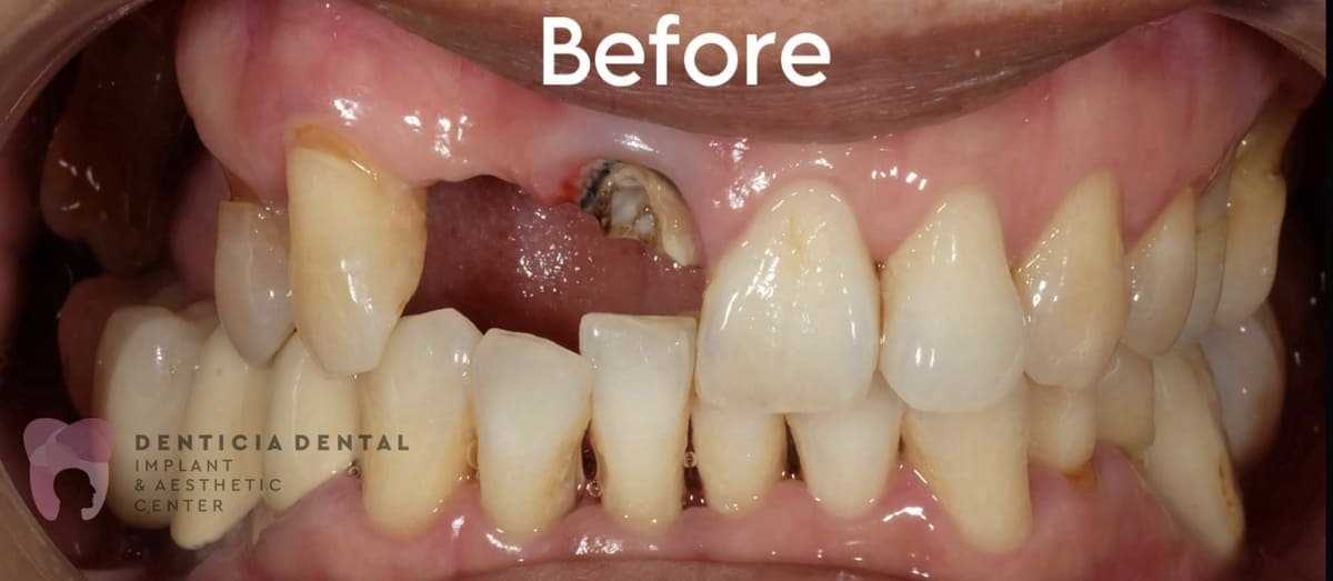 immediate denture before 2