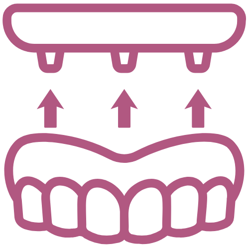 overdenture